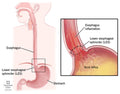Acid Reflux & GERD: Symptoms, What It Is, Causes, Treatment
