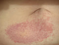 tirzepatide itchy skin tirzepatide itching all over body Not good news from Allergist : r/Zepbound