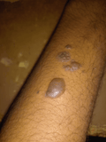 Trigger Warning] Fresh cigarette burn, any tips? : r/SkincareAddiction