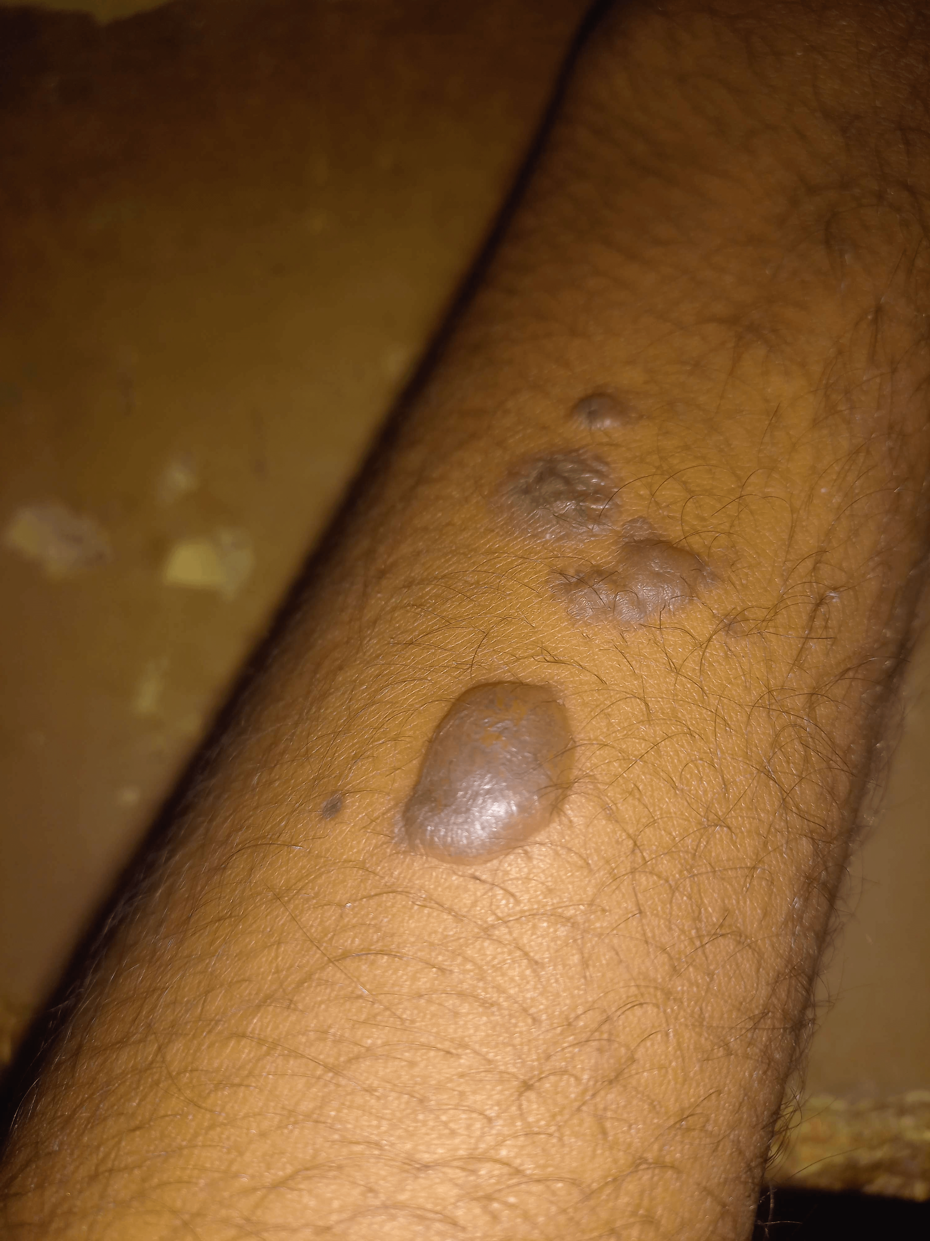 Trigger Warning] Fresh cigarette burn, any tips? : r/SkincareAddiction