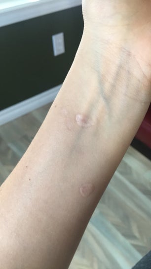 how bad will a cigarette burn scar How can I get rid of cigarette burns on